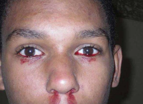 眼睛流血图片 (2)_有来医生