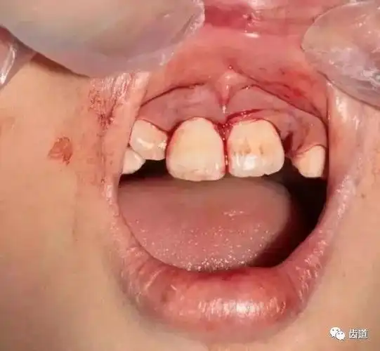 询问了一下父母,本来不是反合的!我们可以看到,牙齿半脱位,牙龈撕裂.