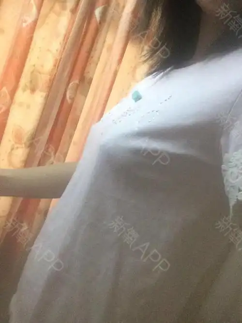 飞公子乳头缩小术后第4天美丽日记_新氧整形
