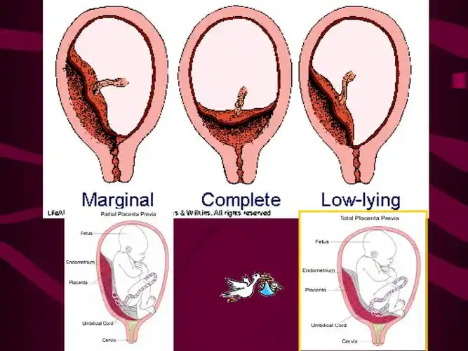 超声医学课件:胎盘脐带异常和滋养细胞疾病超声诊断.ppt