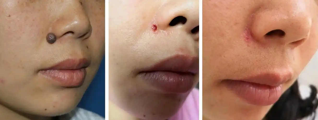 无痕黑痣切除鼻唇沟篇案例