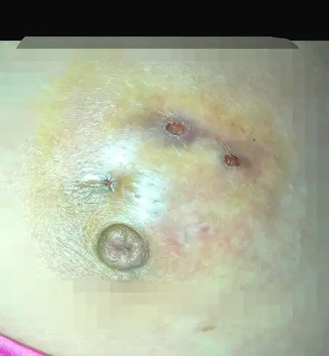 同时也包括一部分初次发病时即表现为既有乳腺肿块,又有脓肿形成的