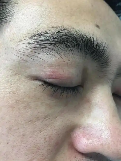 神经性皮炎怎样才能使它不复发(最令人讨厌的神经性皮炎)(1)