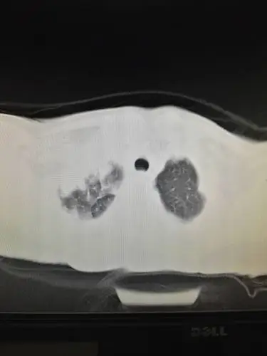 虫蚀空洞结核(哈尔滨胸科医院王秀峰老师)