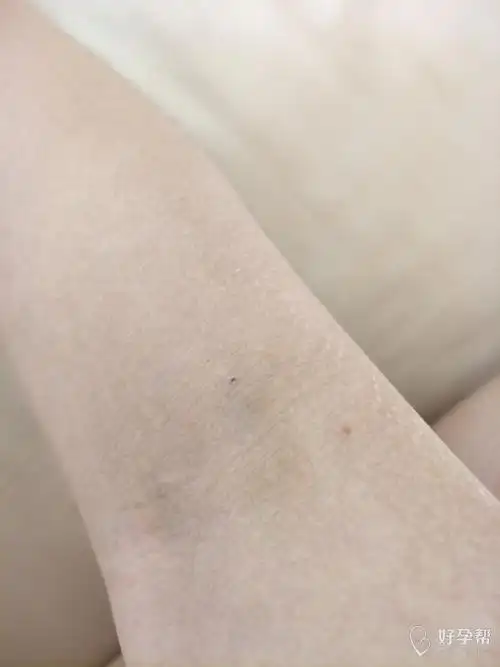 两只手的淤青终于都散了