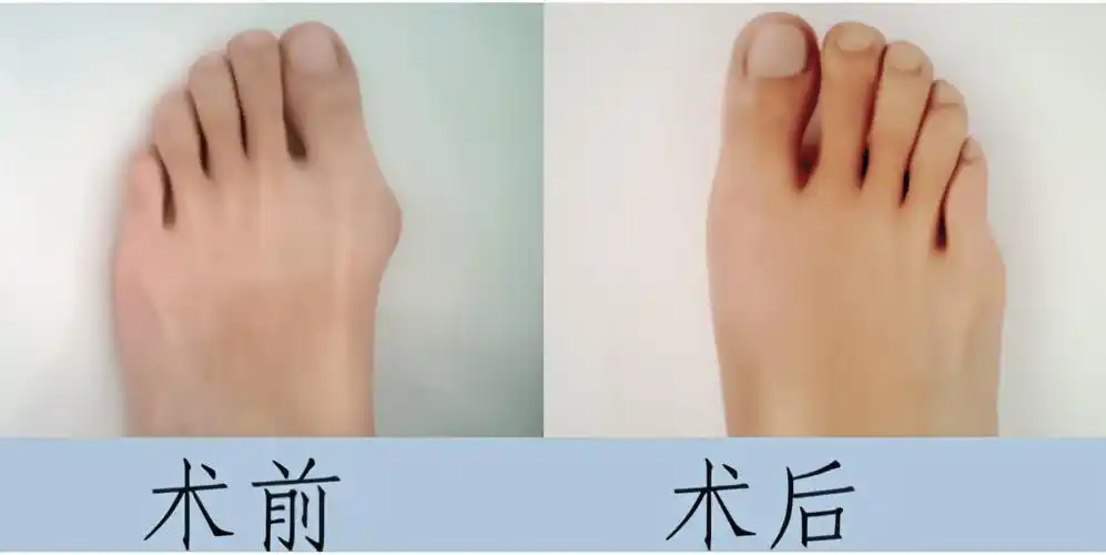 一位拇外翻患者的真实记录_鞋子_挤压_严重