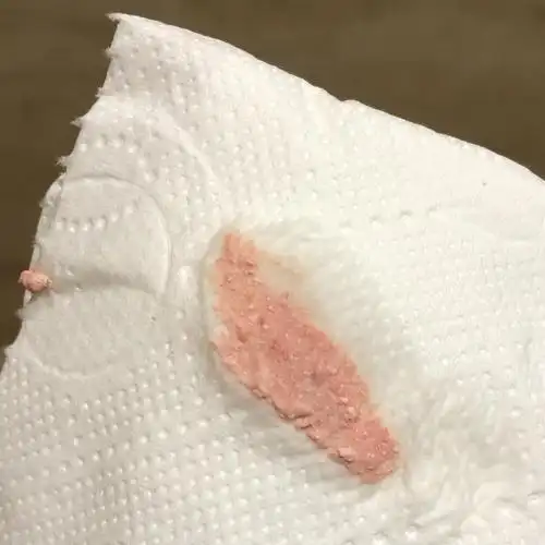 霉菌阴道炎用了凯妮汀后排出粉色分泌物