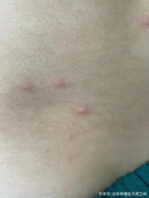 孕妇发水痘怎么办 孕妇发水痘怎么办啊