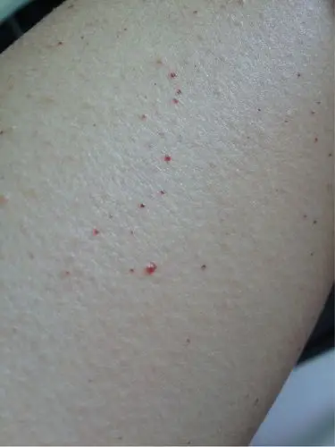 毛细血管与小血管稍受轻微外力撞压即可引起破裂出血而致紫癜