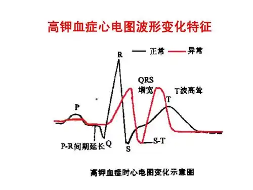 高钾血症心电图波形变化特征