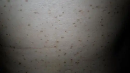 你好,大夫,我想问下我身上这些斑点是怎么回事,从10几岁就开始有了,是