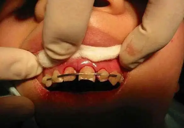 牙齿外伤脱落后如何急救99的人都做错了