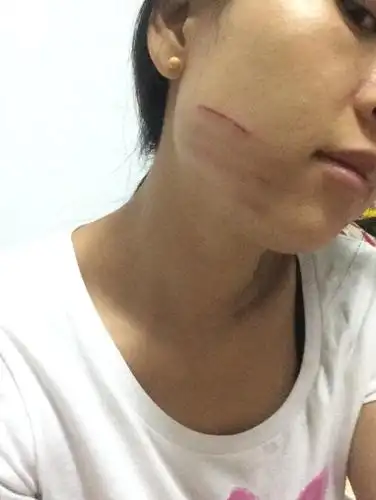 今天和别人发生了矛盾,脸被抓伤了,我是疤痕性皮肤,有什么方法好的快