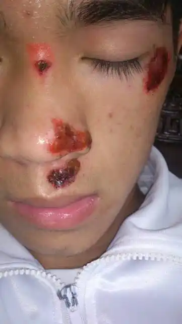 我前两天骑车摔伤了脸部很红开始结痂了还可以用 薰衣草精油, 完美