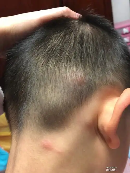 宝宝头上突然出现很多大包