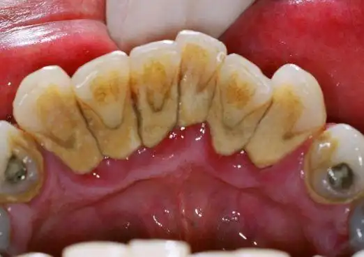 也没有看到牙结石,为什么还要洗牙来清除