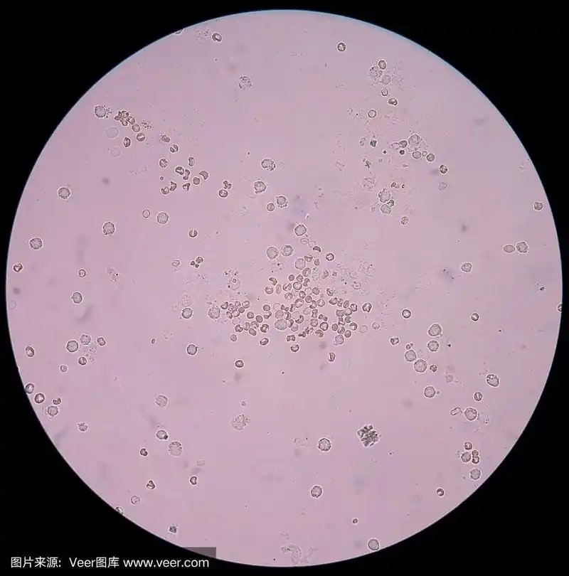 尿检中有新鲜红细胞.