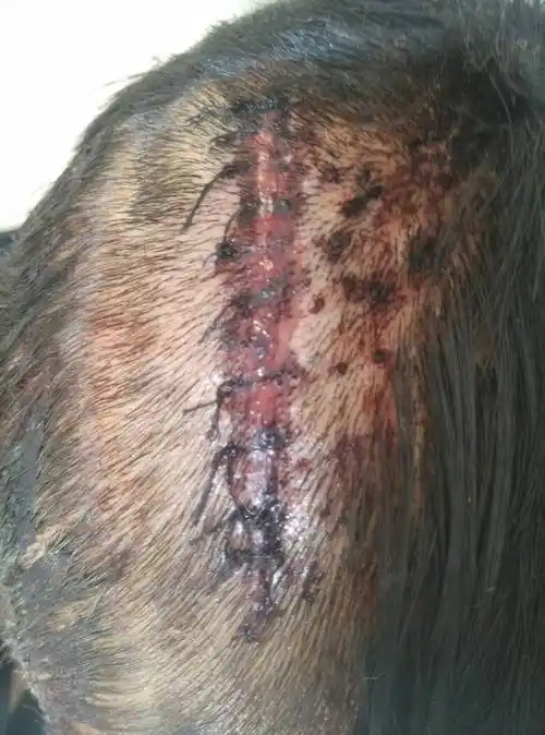 脑部受伤,钝器伤6公分左右,至脑膜,伤情鉴定管的严不,给点好处能不能