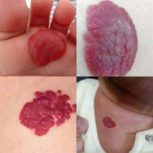 婴幼儿血管瘤会自行消退?小心长在这些部位的"瘤",或危及生命