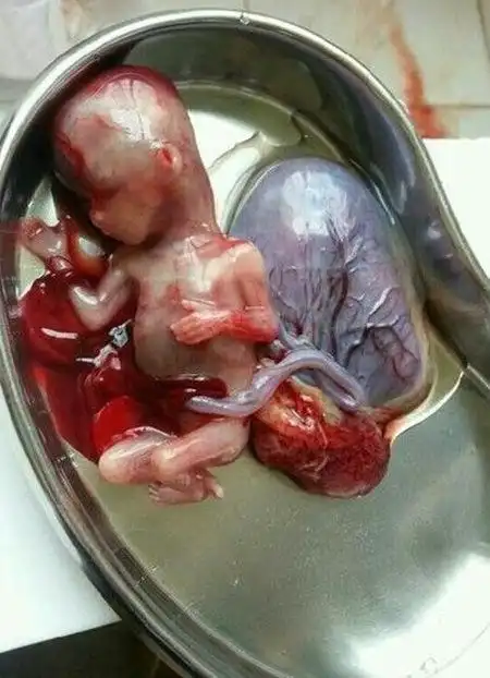 打胎记录怎么查出来 一组强行堕胎的记录