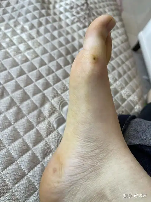 跖疣第一次冷冻第六天