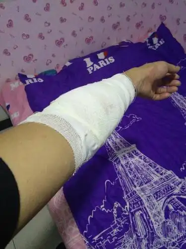 手臂受伤缝了十针,多久可以拆线,多久可以恢复,会不会留疤