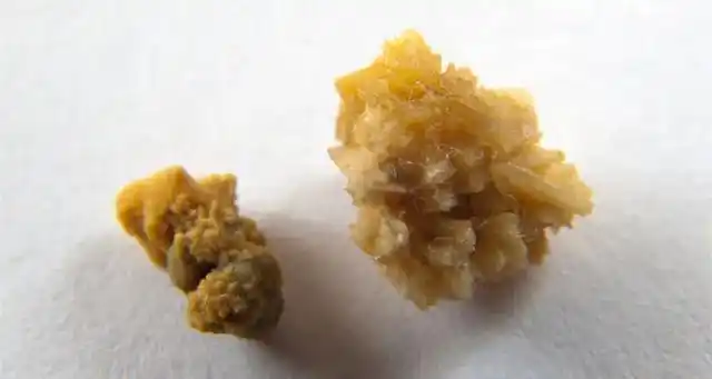 大约80%的肾结石为草酸钙结石.