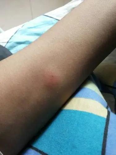 结核皮试每天变化图片