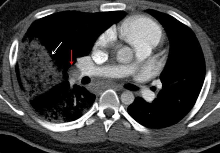 患者肺栓塞ct可见右肺动脉主干栓塞(红色箭头)及大面积肺梗死