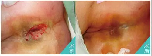 肛瘘患者术后照片图片