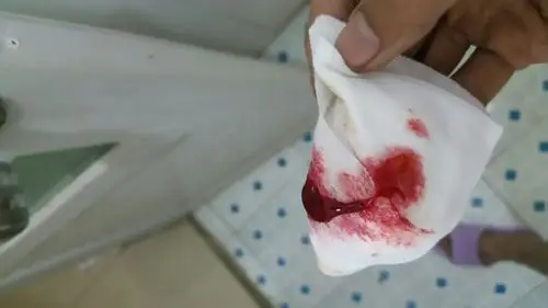 肛肠科,求助这几天大便出血,而且出的不是一般的多,有时候一坑都是