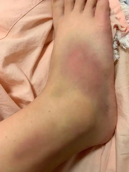 脚扭伤两个月了,为什么还是有疼痛感,按压之后还会出现淤青? - 知乎