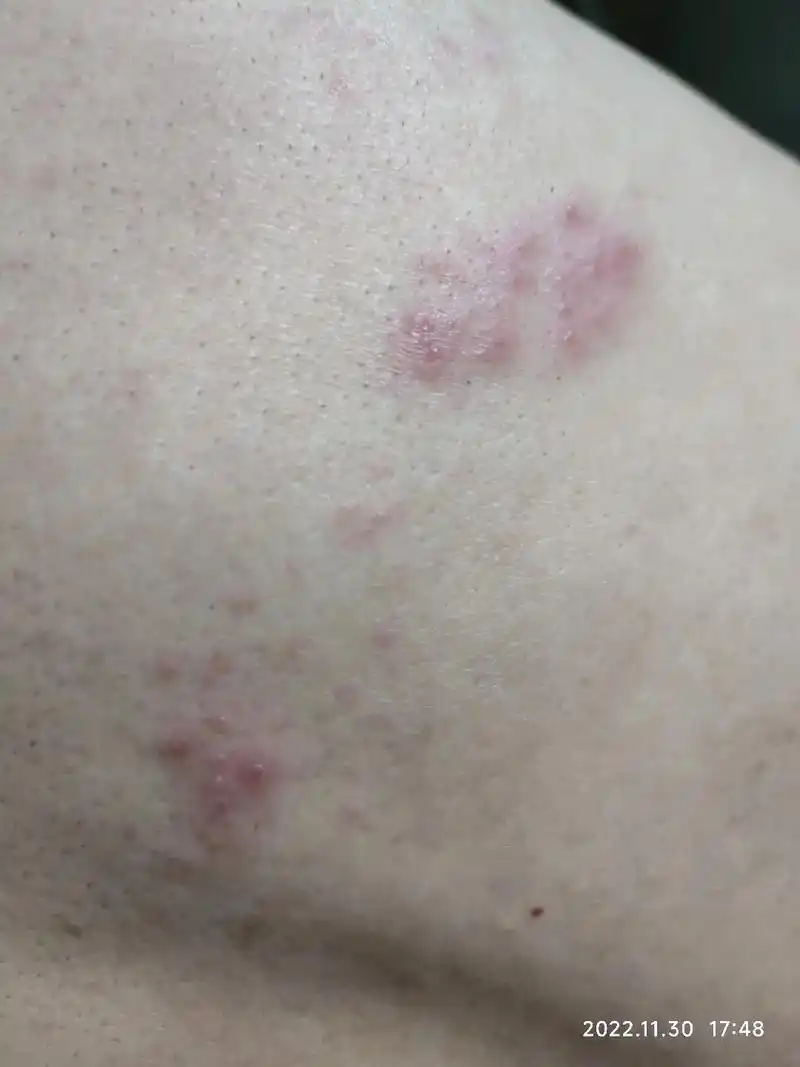 54岁,男,1周前不明原因右中腹皮肤疼痛难忍,不红不肿不痒, - 抖音