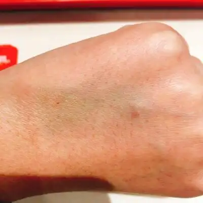 12.28针眼与输液