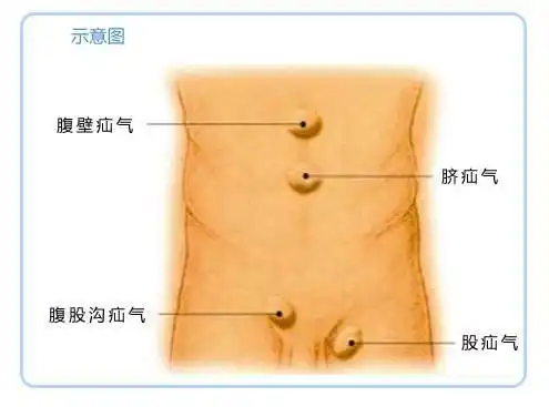 疝气男女老少都会有?哪些人是疝气的高危人群?手术治疗会复发吗