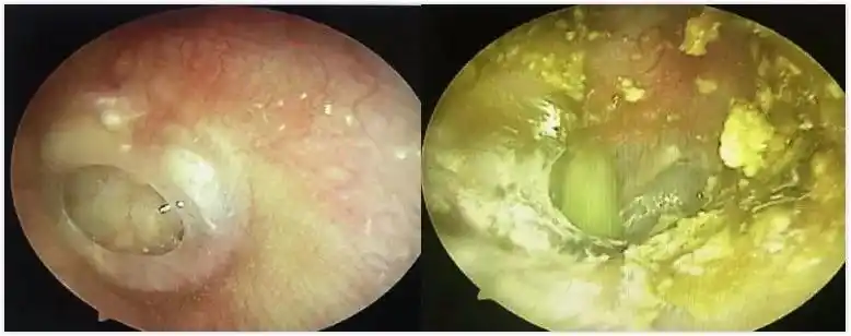 中耳炎致听力下降,求医20年未果,在中民术后第四天听力明显好转