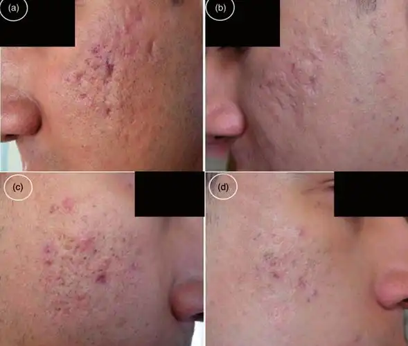 微针技术导入prp治疗痤疮瘢痕(痘坑)