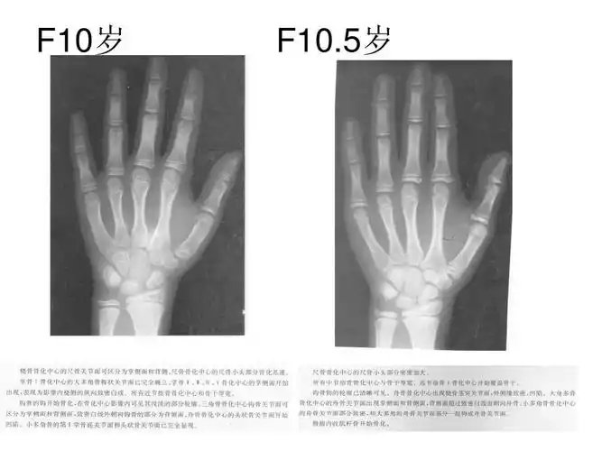 骨龄图谱_女