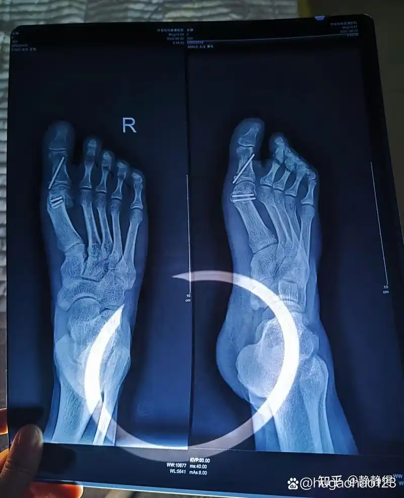 拇外翻大脚骨截骨手术后半年