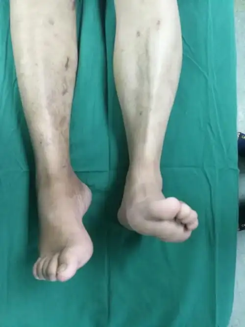 外固定架矫正马蹄内翻足 - 好大夫在线