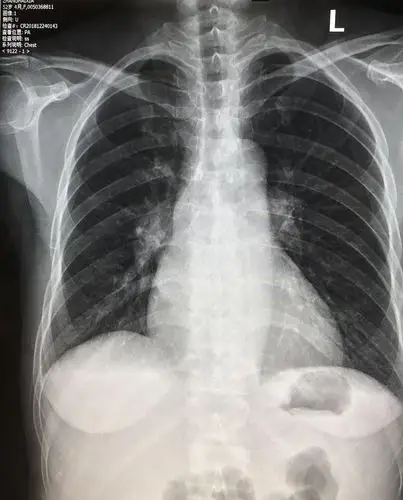 病例3:肺血基本正常,肺门影略大,双房影,心膈面延长.