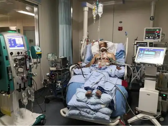 "四大救命神器"联合应用 (呼吸机 eit 血滤机 ecmo)