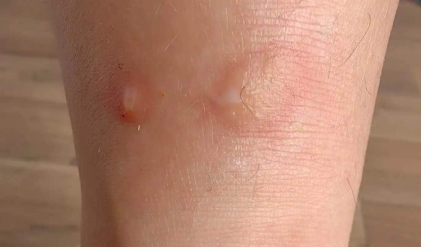 怎么会有跳蚤这么讨厌的东西[抓狂][抓狂] 据说人体质不同对跳蚤毒液