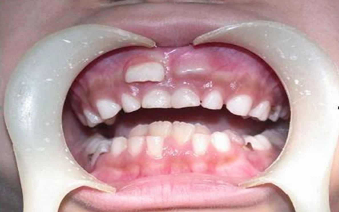 宝宝换牙期间如何避免孩子出现双排牙牙齿长歪的情况呢