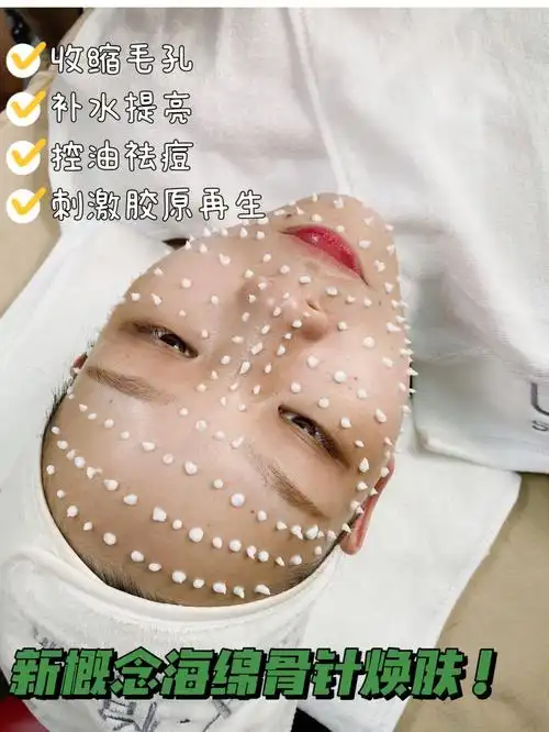 美容院祛痘必备78海绵骨针真的绝了