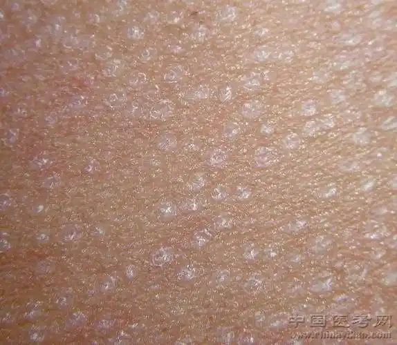 密集恐惧症及非医护人员慎点!史上最全的皮肤病图谱来了(修订版)!_凤