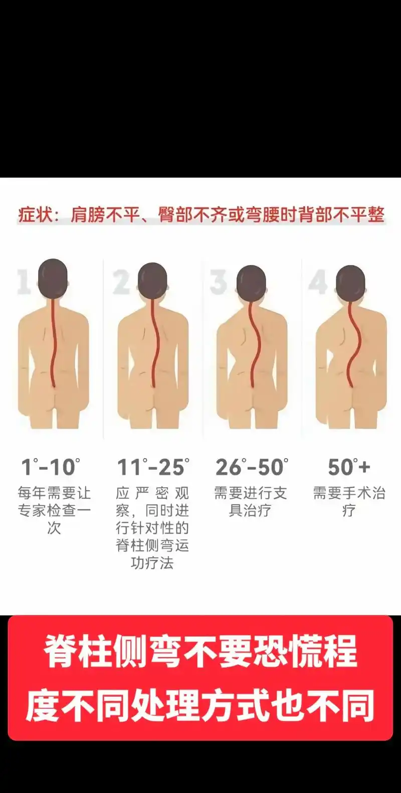 脊柱侧弯不要恐慌,侧弯程度不同,处理方式也不同