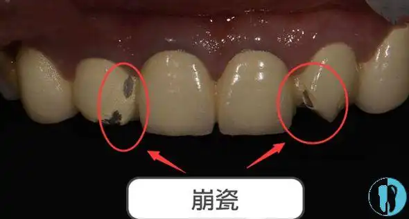 聊一聊二氧化锆全瓷牙和烤瓷牙哪个更受大众青睐