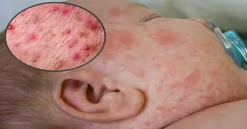 孙女全身长满了痱子!日本奶奶用「这个」涂满孙女全身,不到一天痱子竟