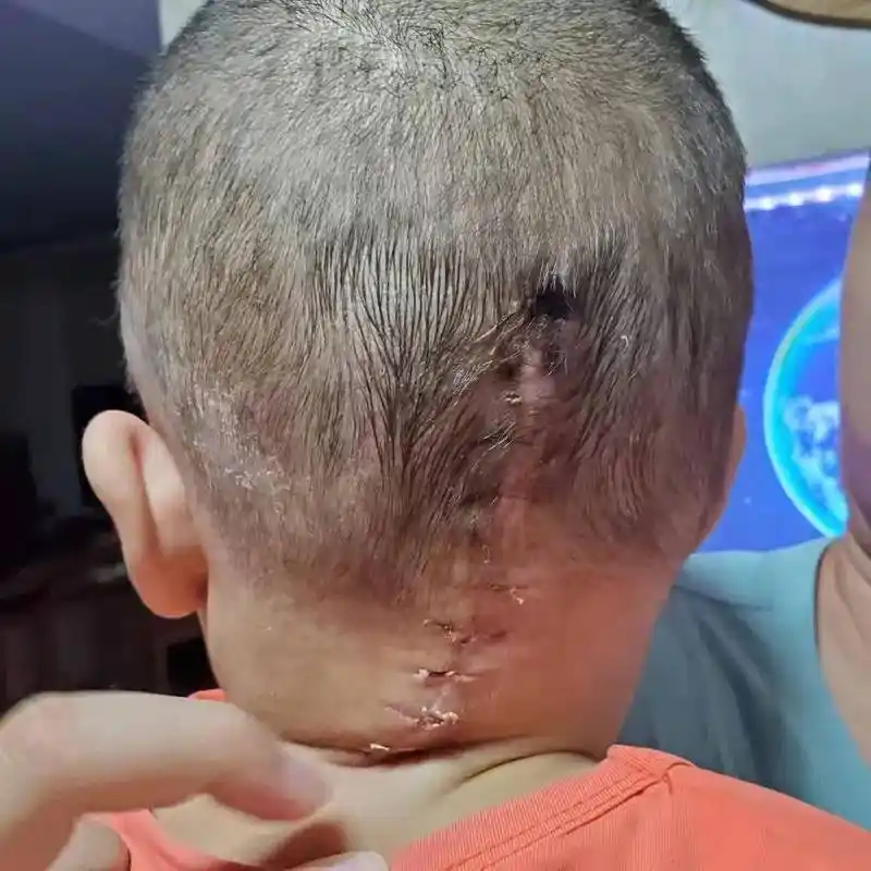 青县两岁孩子头部恶性肿瘤一周做了两次开颅手术